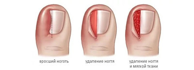 Хирургическое лечение Хирургическое лечение