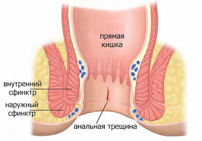 Анальная трещина