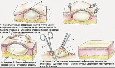 Лечение атеромы